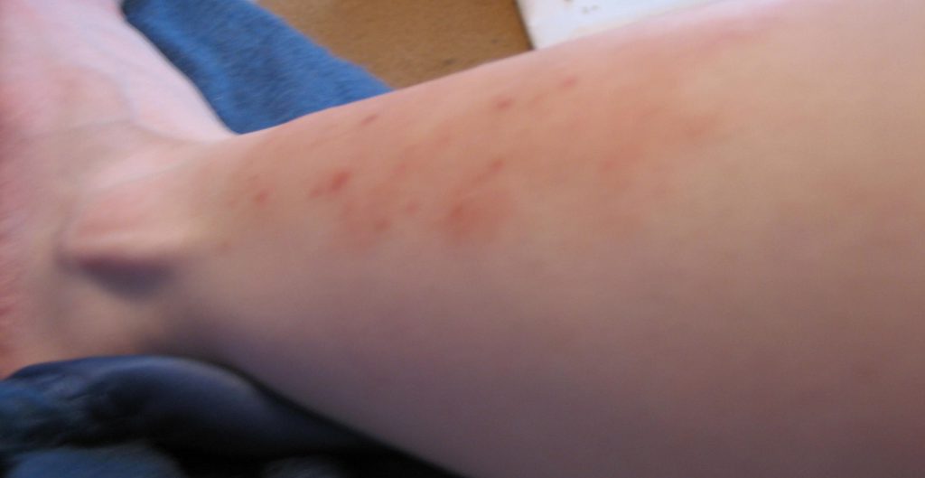 Dec 24, 2006. Most likely Dermatitis Herpetiformis (Celiac rash). Went away after being gluten free for months.